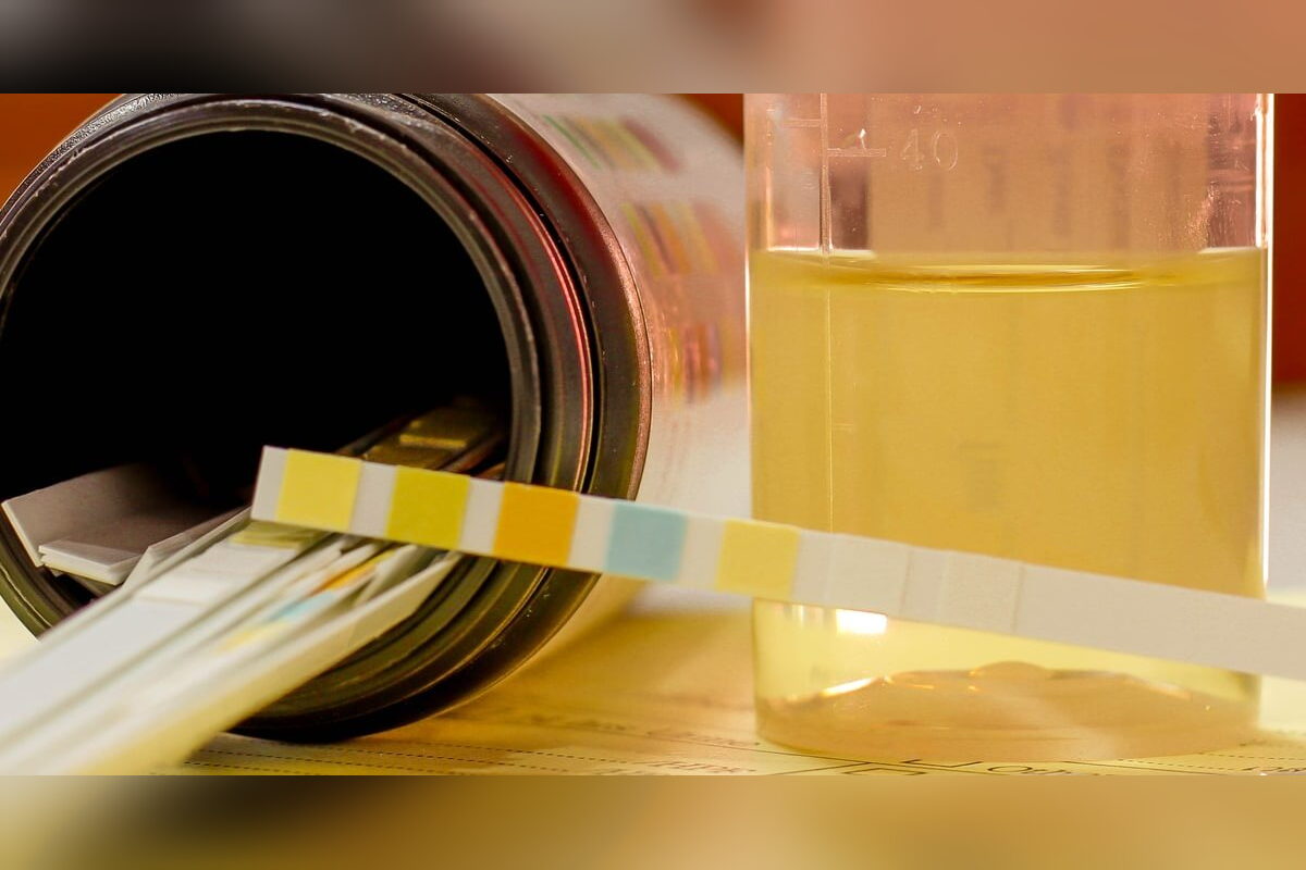 Urine test strip dipped in a sample next to its color chart bottle
